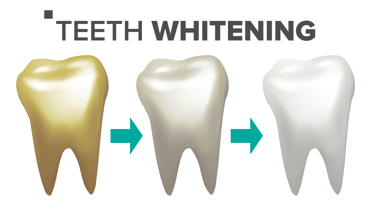 Teeth Whitening Process