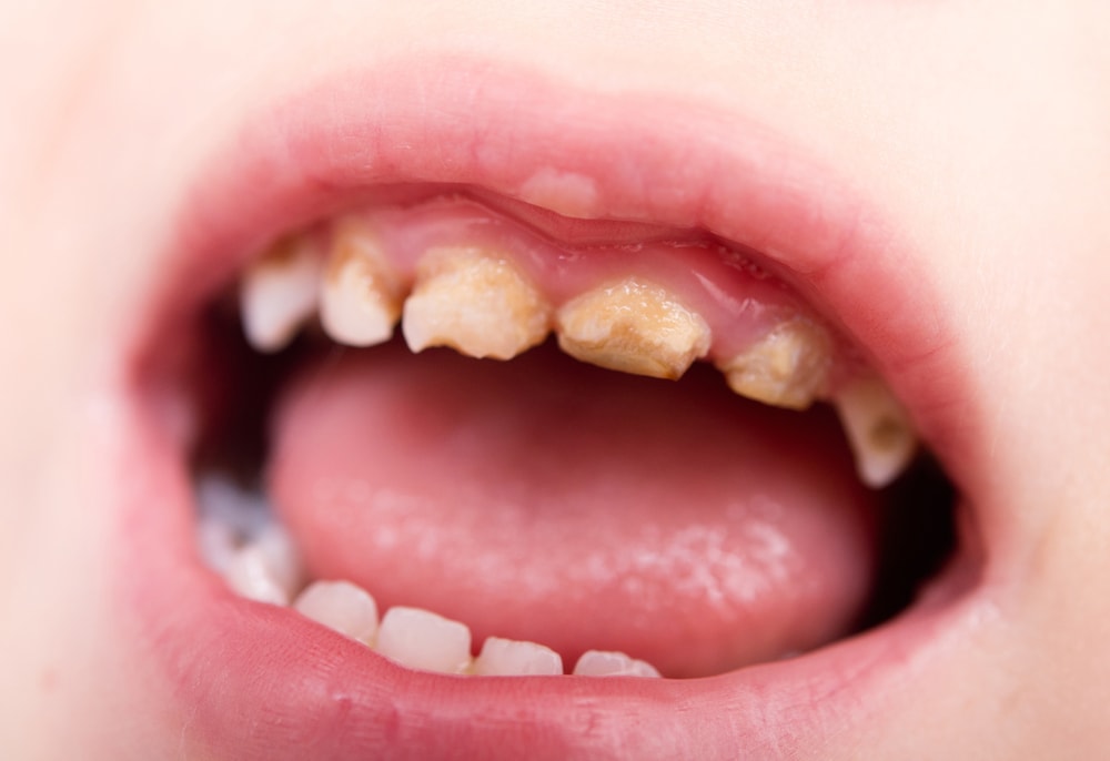 tooth decay in children