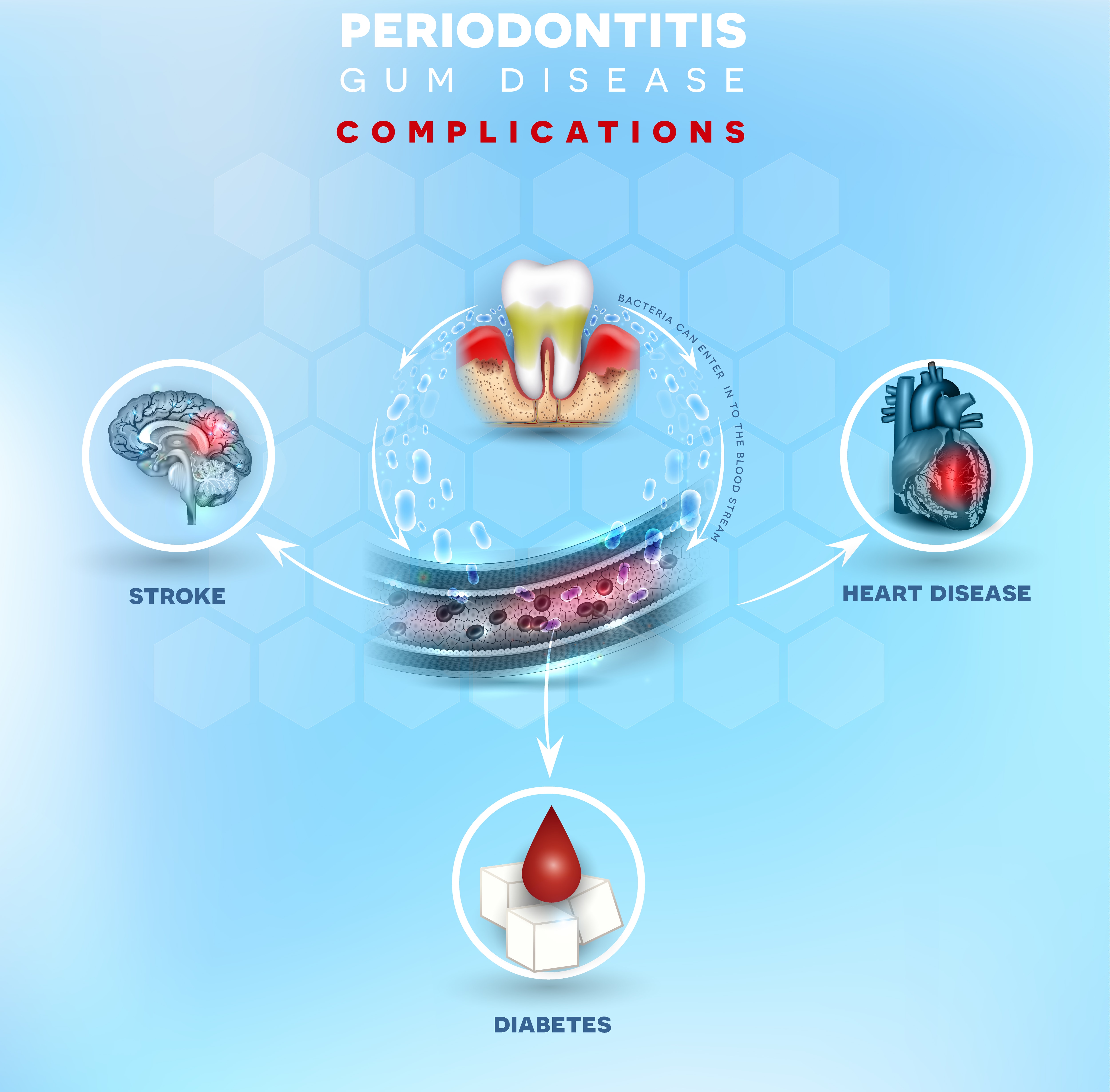 periodontal disease complications