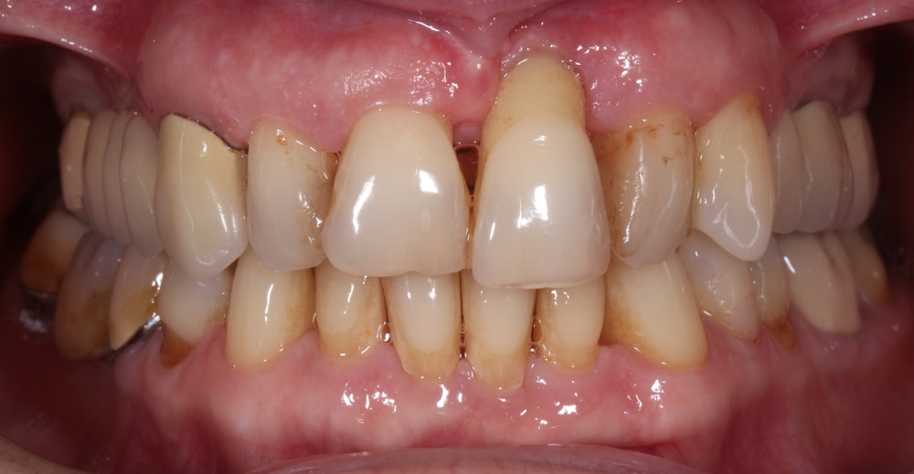 periodontal gum disease 