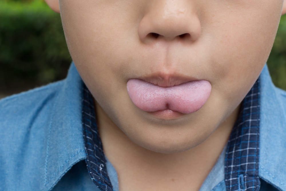 ankyloglossia in children