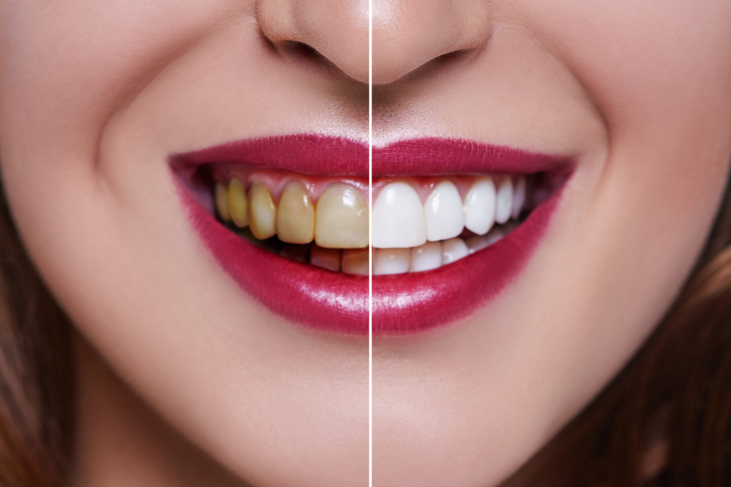 How Long Do Veneers Last? Hint: It Depends On The Material