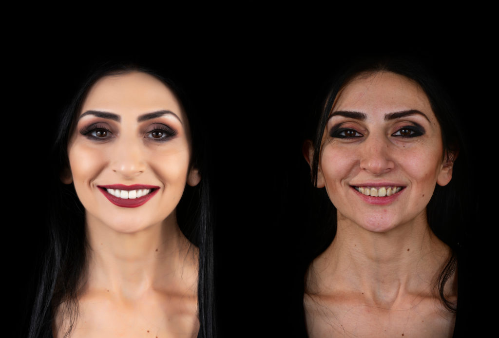 before and after picture for a young lady after having her ceramic veneers