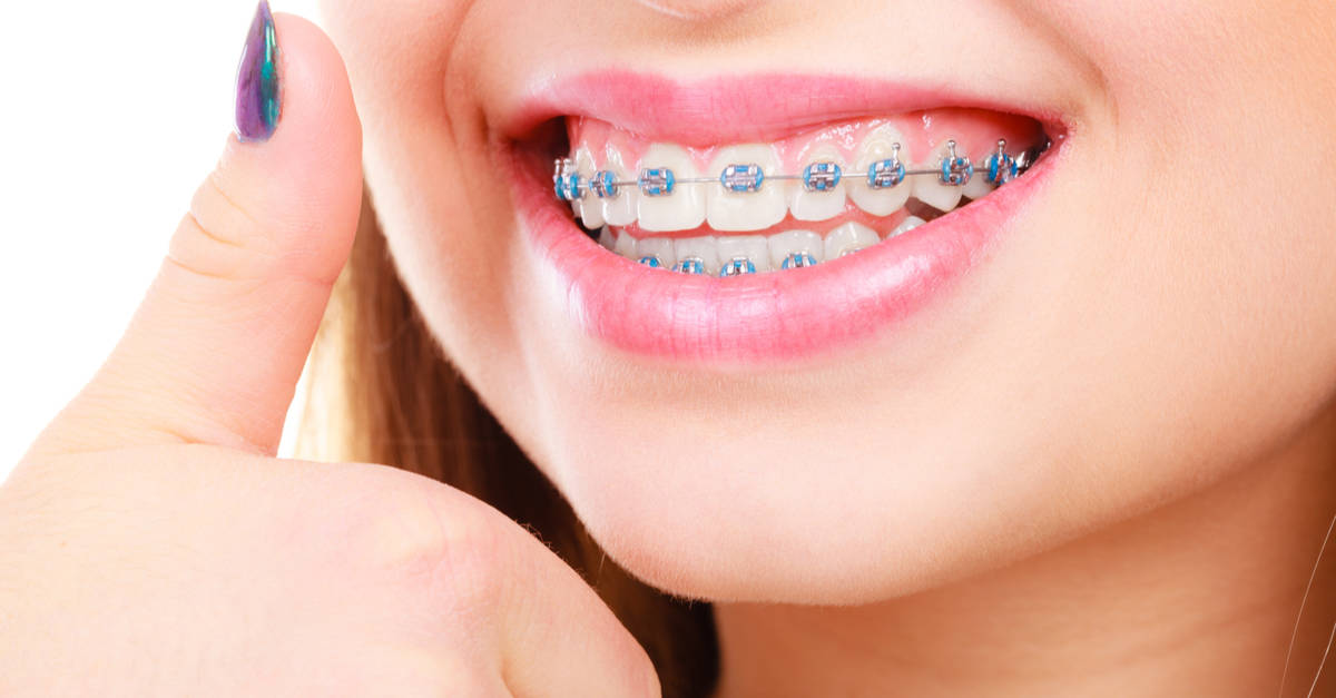 Invisalign Vs Braces: Which One Is Better?