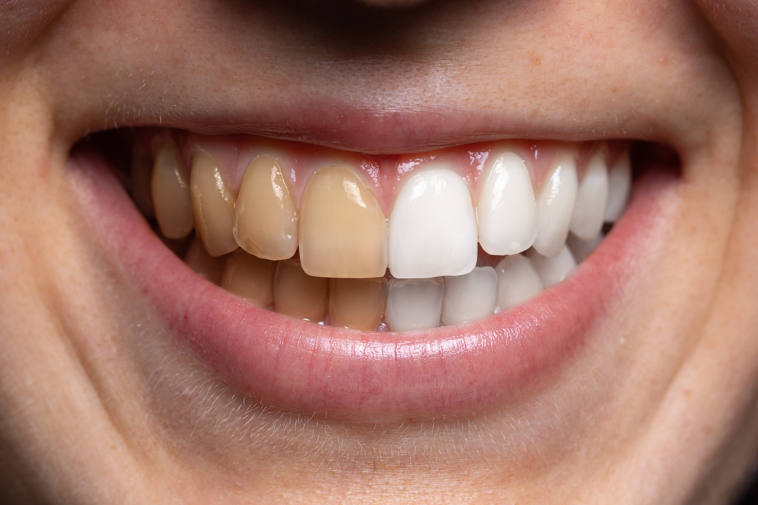 Are At-Home Teeth Whitening Kits Safe/Good? | Mona Vale Dental