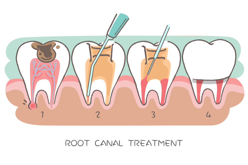 RCT for pulp tissue damage