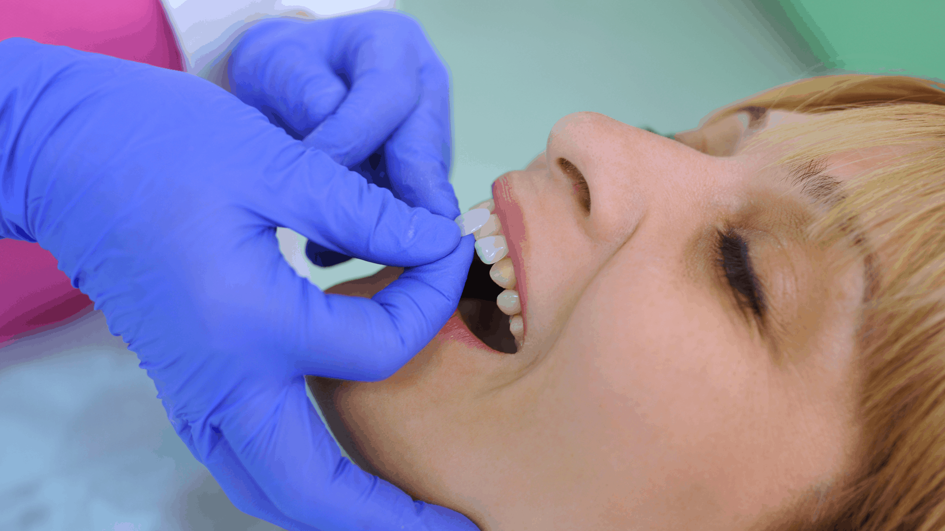 Do veneers ruin your teeth? (no, but here's a warning)