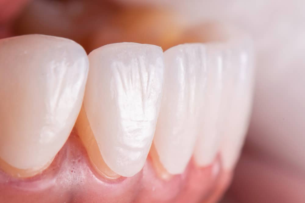 Do veneers ruin your teeth? (no, but here's a warning)