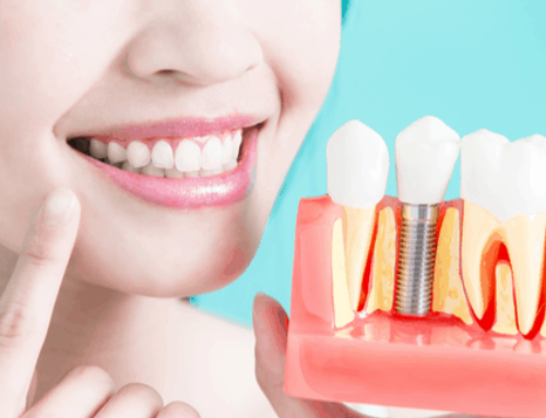 Dental implants cost (Sydney)