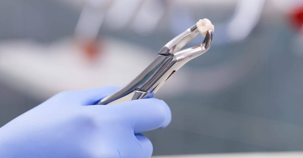 Wisdom Teeth Removal Comprehensive Guide by Dr. Alistair