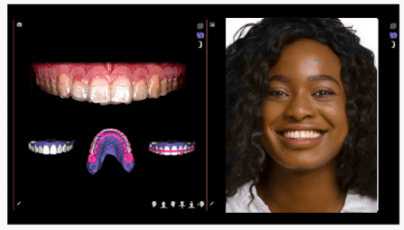 cosmetic dentistry with digital smile design