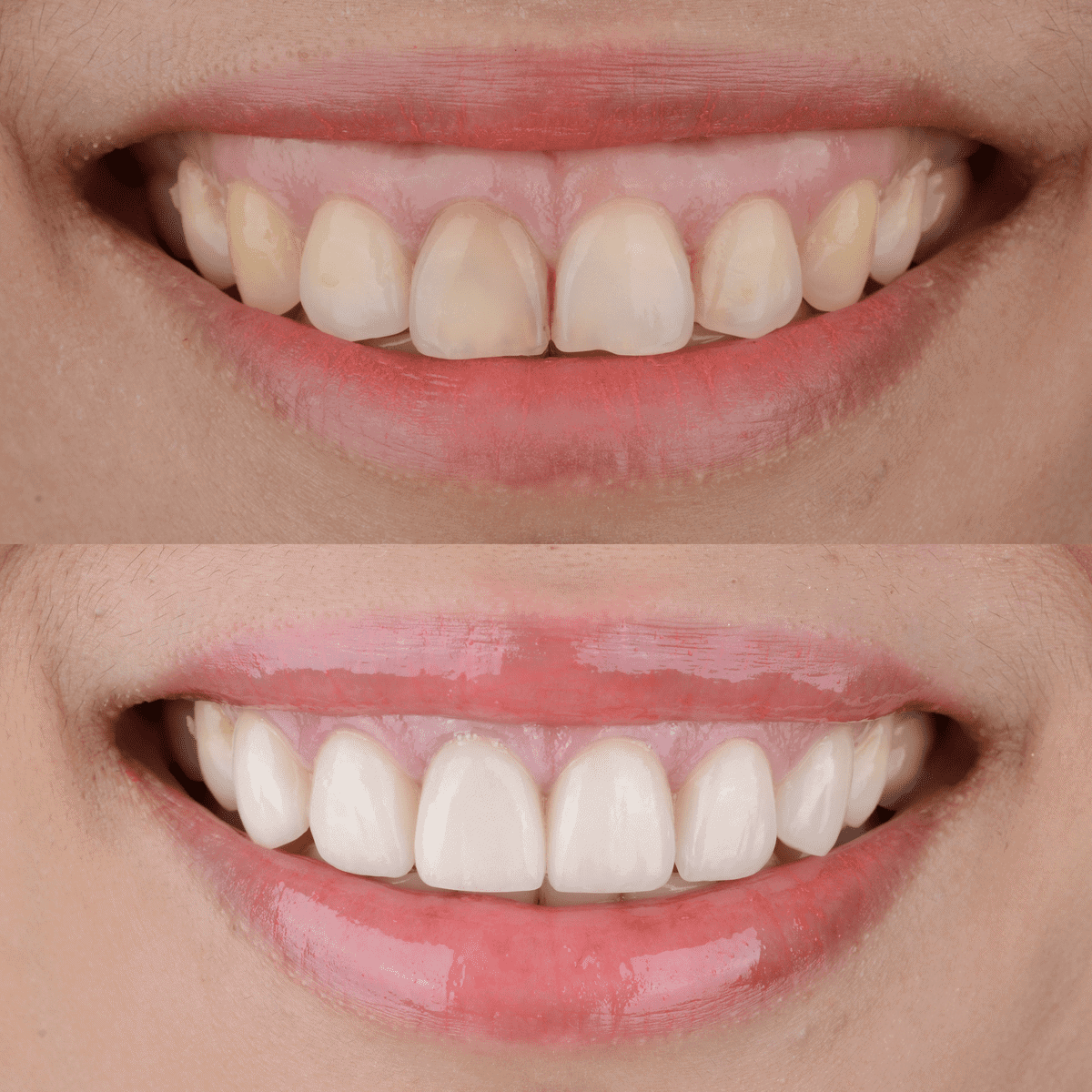 A comparison of excessive gingival display before and after treatment