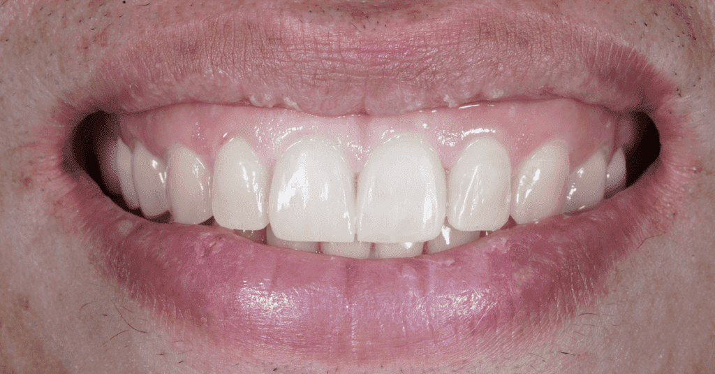 Want to know how to fix a gummy smile? We'll show you how...