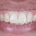 Want to know how to fix a gummy smile? We'll show you how...