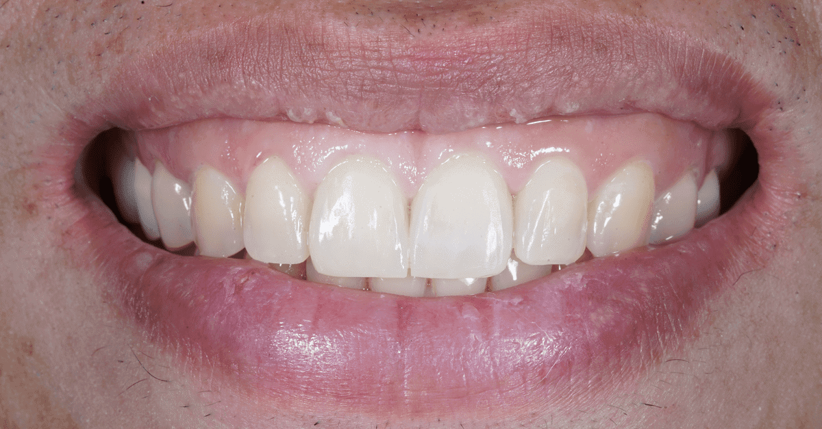 how to fix gummy smile