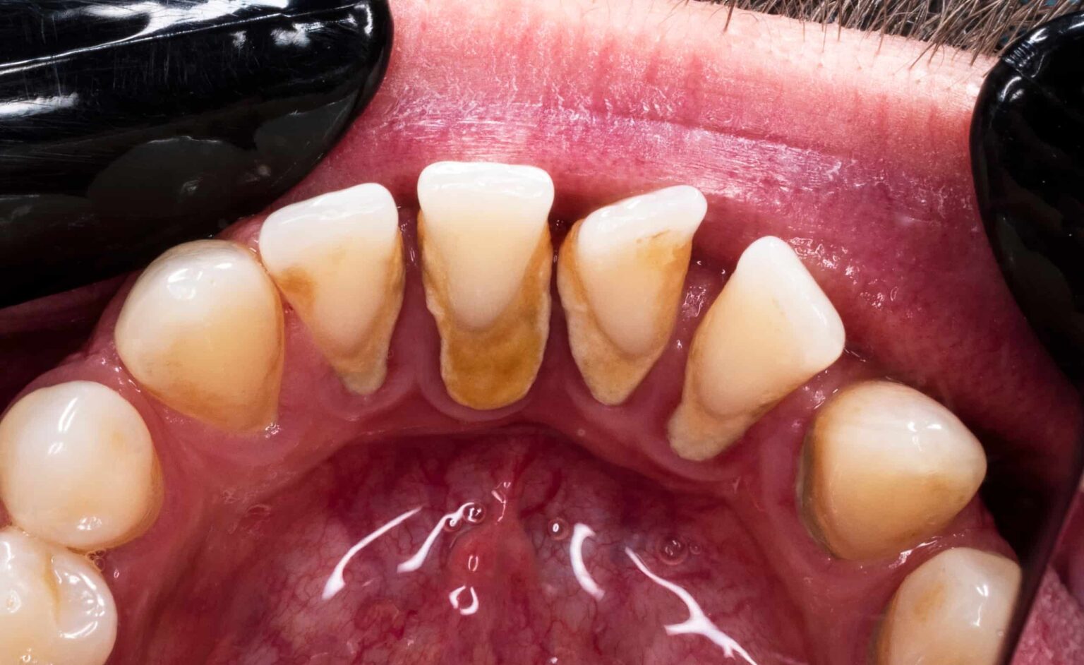 Is Vaping Bad for Your Teeth? (Yes, According to Research)