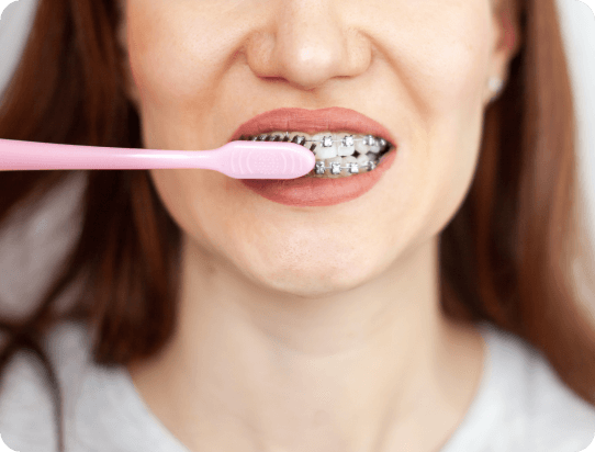 Teeth Straightening With Braces - Mona Vale Dental